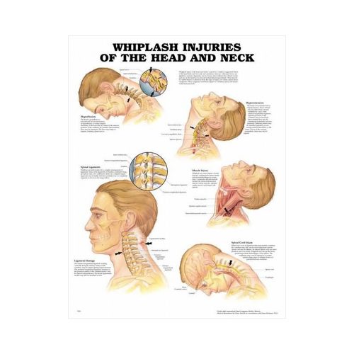 Anatomisk Plansch “Whiplash Injuries of the Head and Neck” 66 x 51 cm